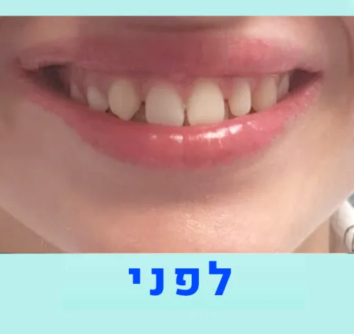 עבודת שיקום שיניים במעבדה